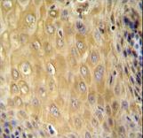 C6orf70 antibody immunohistochemistry of formalin-fixed and paraffin-embedded human esophageal carcinoma followed by peroxidase-conjugated secondary antibody and DAB staining.