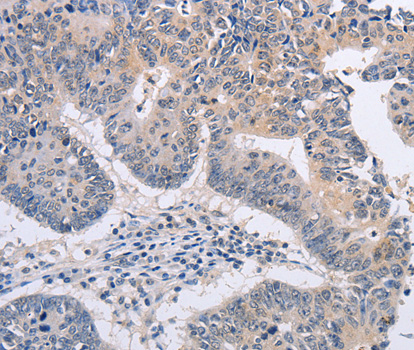 Immunohistochemistry of paraffin-embedded human colon cancer tissue using FBXO32 antibody.
