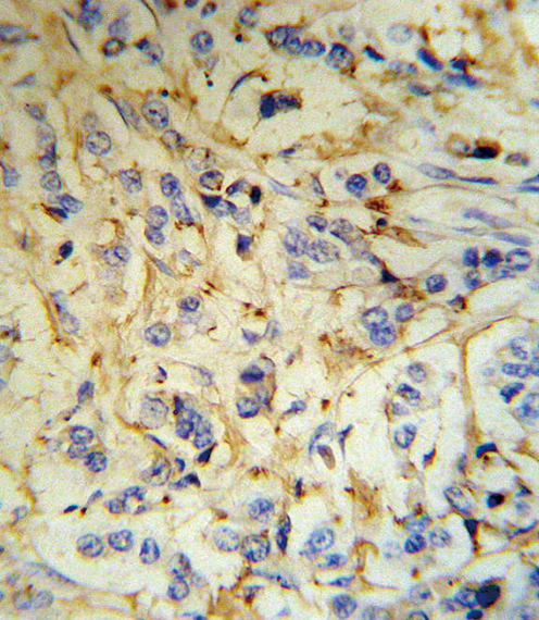 FGA Antibody (RB18707) IHC of formalin-fixed and paraffin-embedded human breast carcinoma tissue followed by peroxidase-conjugated secondary antibody and DAB staining.
