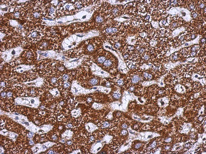 IHC of paraffin-embedded Hepatoma, using TOM1L1 antibody at 1:500 dilution.