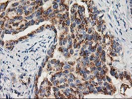 IHC of paraffin-embedded Carcinoma of Human lung tissue using anti-TOMM34 mouse monoclonal antibody.