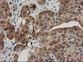 IHC of paraffin-embedded Carcinoma of Human bladder tissue using anti-TOMM34 mouse monoclonal antibody.