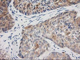 IHC of paraffin-embedded Adenocarcinoma of Human breast tissue using anti-TOMM34 mouse monoclonal antibody.