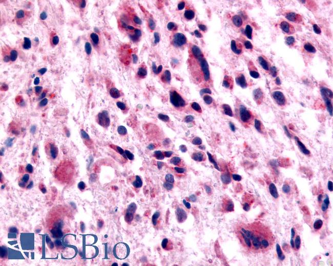 Anti-GABABR1 / GABBR1 antibody IHC of human Brain, Glioblastoma. Immunohistochemistry of formalin-fixed, paraffin-embedded tissue after heat-induced antigen retrieval.