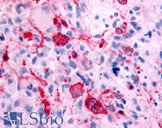 Anti-GABABR1 / GABBR1 antibody IHC of human Brain, Glioblastoma. Immunohistochemistry of formalin-fixed, paraffin-embedded tissue after heat-induced antigen retrieval.