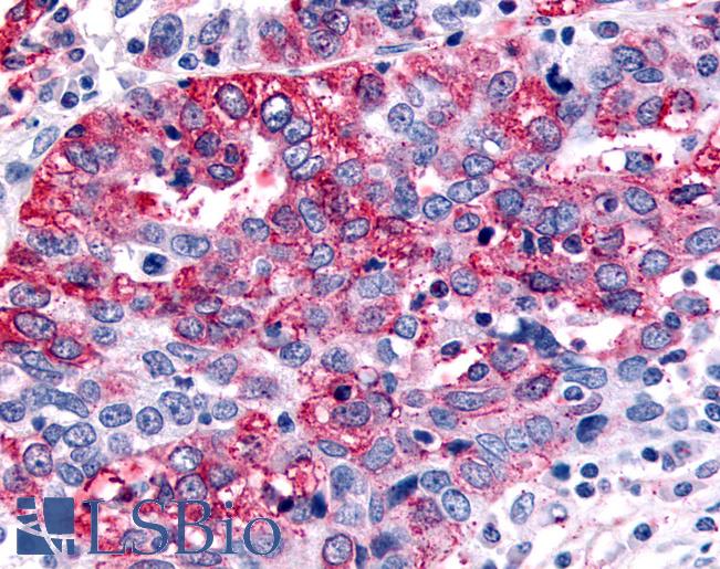 Anti-GABABR1 / GABBR1 antibody IHC of human Ovary, Carcinoma. Immunohistochemistry of formalin-fixed, paraffin-embedded tissue after heat-induced antigen retrieval.