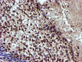 IHC of paraffin-embedded Carcinoma of Human bladder tissue using anti-TOMM34 mouse monoclonal antibody.