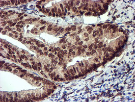 IHC of paraffin-embedded Adenocarcinoma of Human endometrium tissue using anti-TOMM34 mouse monoclonal antibody.
