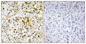 IHC of paraffin-embedded human liver carcinoma tissue, using LEG4 Antibody. The picture on the right is treated with the synthesized peptide.