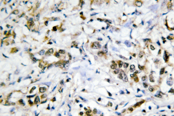 IHC of Galectin-4 (K83) pAb in paraffin-embedded human liver carcinoma tissue.