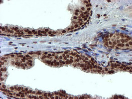 IHC of paraffin-embedded Carcinoma of Human prostate tissue using anti-TOMM34 mouse monoclonal antibody.