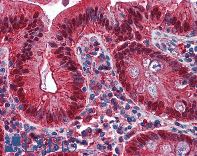 Anti-Galectin 4 antibody IHC of human colon. Immunohistochemistry of formalin-fixed, paraffin-embedded tissue after heat-induced antigen retrieval. Antibody LS-B6110 concentration 1.25 ug/ml.