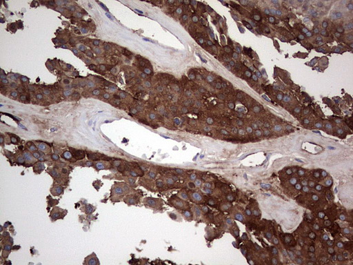 IHC of paraffin-embedded Carcinoma of Human thyroid tissue using anti-GARS mouse monoclonal antibody. (Heat-induced epitope retrieval by 1 mM EDTA in 10mM Tris, pH8.5, 120°C for 3min).