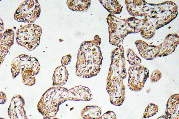 IHC of GCLM (V91) pAb in paraffin-embedded human prostate carcinoma tissue.