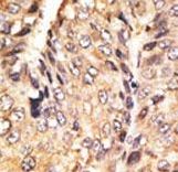 Formalin-fixed and paraffin-embedded human cancer tissue reacted with the primary antibody, which was peroxidase-conjugated to the secondary antibody, followed by DAB staining. This data demonstrates the use of this antibody for immunohistochemistry; clinical relevance has not been evaluated. BC = breast carcinoma; HC = hepatocarcinoma.