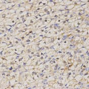 Immunohistochemistry of paraffin-embedded human kidney cancer tissue using GJC2 antibody at dilution of 1:200 (x400 lens)
