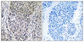 IHC of paraffin-embedded human lung carcinoma tissue, using BRP16 Antibody. The picture on the right is treated with the synthesized peptide.