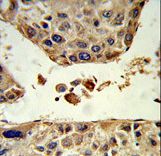 Formalin-fixed and paraffin-embedded human hepatocarcinoma reacted with HPD Antibody , which was peroxidase-conjugated to the secondary antibody, followed by DAB staining. This data demonstrates the use of this antibody for immunohistochemistry; clinical relevance has not been evaluated.