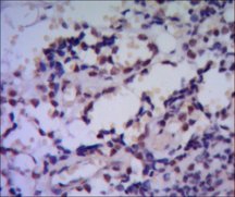IHC of paraffin-embedded human breast cancer using HSP70 mouse mAb with DAB staining.