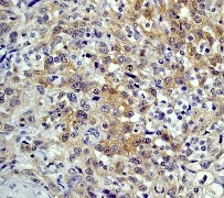 IHC of paraffin-embedded urinary bladder carcinoma using anti-Hsp90 beta (N-term) antibody.