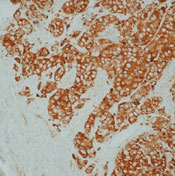Formalin-fixed, paraffin-embedded human breast carcinoma stained with peroxidase-conjugate and DAB chromogen. Note intense cytoplasmic staining of tumor cells.