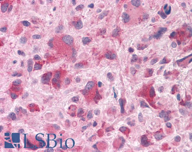 Anti-HTR7 / 5-HT7 Receptor antibody IHC of human Brain, Glioblastoma. Immunohistochemistry of formalin-fixed, paraffin-embedded tissue after heat-induced antigen retrieval.