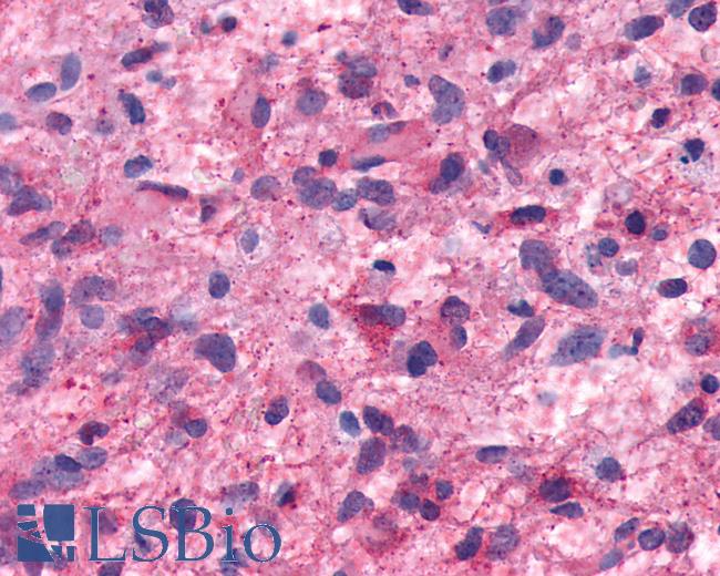 Anti-HTR7 / 5-HT7 Receptor antibody IHC of human Brain, Glioblastoma. Immunohistochemistry of formalin-fixed, paraffin-embedded tissue after heat-induced antigen retrieval.