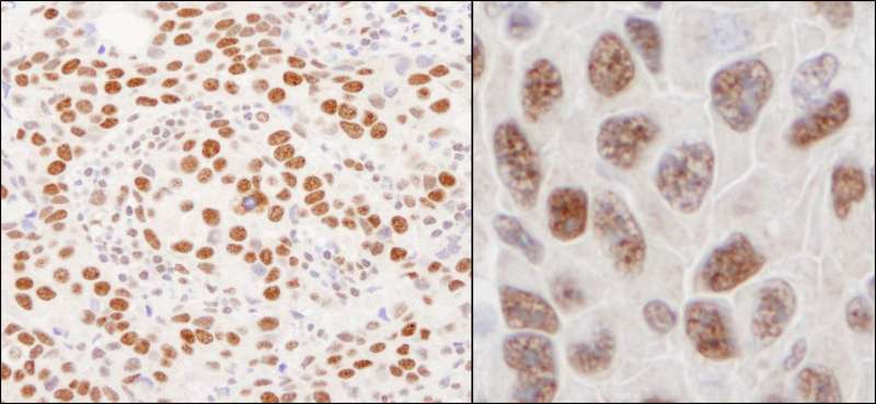 Detection of Human and Mouse hnRNP-U by Immunohistochemistry. Sample: FFPE section of human breast carcinoma (left) and mouse squamous cell carcinoma (right). Antibody: Affinity purified rabbit anti-hnRNP-U used at a dilution of 1:200 (1 Detection: DAB.