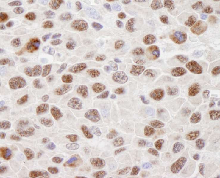 Detection of Mouse hnRNP-U by Immunohistochemistry. Sample: FFPE section of mouse squamous cell carcinoma. Antibody: Affinity purified rabbit anti-hnRNP-U used at a dilution of 1:250. Detection: DAB staining using anti-Rabbit IHC antibody at a dilution of 1:100.
