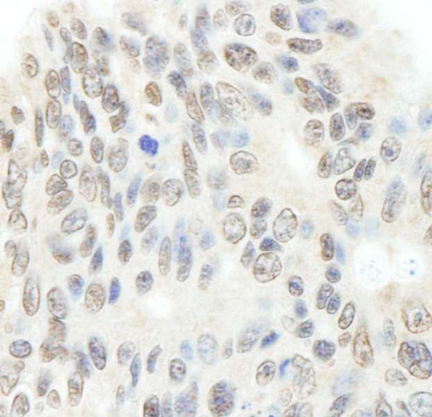 Detection of Human Topo II Beta by Immunohistochemistry. Sample: FFPE section of human ovarian carcinoma. Antibody: Affinity purified rabbit anti-Topo II Beta used at a dilution of 1:200 (1 ug/ml). Detection: DAB.