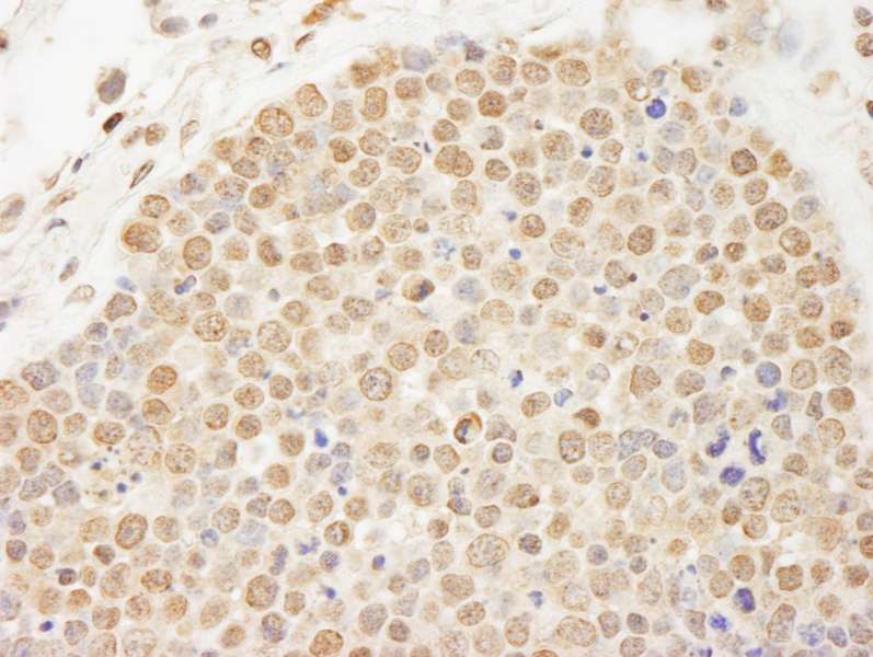 Detection of Human Topo II Beta by Immunohistochemistry. Sample: FFPE section of human small cell lung cancer. Antibody: Affinity purified rabbit anti-Topo II Beta used at a dilution of 1:200 (1 ug/ml). Detection: DAB.