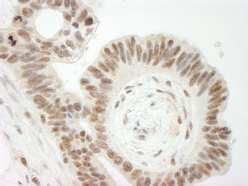Detection of Human Topo II Beta by Immunohistochemistry. Sample: FFPE section of human ovarian cancer. Antibody: Affinity purified rabbit anti-Topo II Beta used at a dilution of 1:250.