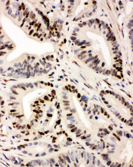 IRF1 / IRF-1 /MAR antibody. IHC(P): Human Intestinal Cancer Tissue.