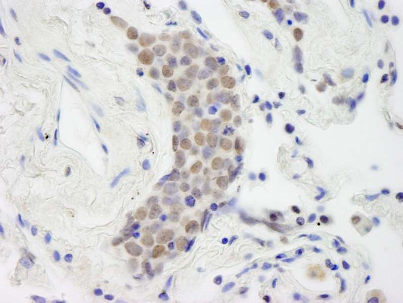 Detection of Human Topo II Beta by Immunohistochemistry. Sample: FFPE section of human small cell lung cancer. Antibody: Affinity purified rabbit anti-Topo II Beta used at a dilution of 1:250.