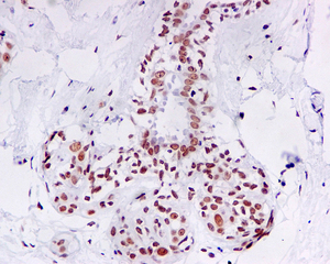 IHC of paraffin-embedded human breast tissue using anti-Topoisomerase II Beta antibody.