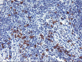 IHC of paraffin-embedded Human lymphoma tissue using anti-IGJ mouse monoclonal antibody.