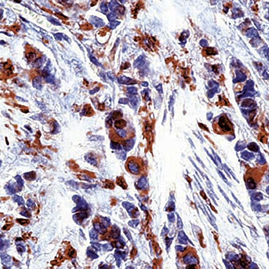Formalin-fixed, paraffin-embedded human breast carcinoma stained with Thymidine Phosphorylase antibody LS-C95495.