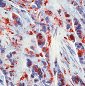 Formalin-fixed, paraffin-embedded human breast carcinoma stained with peroxidase-conjugate and AEC chromogen. Note nuclear and cytoplasmic staining of tumor cells.