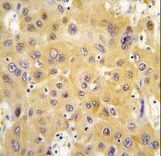 Formalin-fixed and paraffin-embedded human hepatocarcinoma tissue reacted with ECGF1 antibody , which was peroxidase-conjugated to the secondary antibody, followed by DAB staining. This data demonstrates the use of this antibody for immunohistochemistry; clinical relevance has not been evaluated.