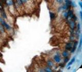 IHC of CK 8/35âH11 on FFPE Prostatic Adenocarcinoma tissue.