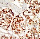 Formalin-fixed and paraffin-embedded human cancer tissue reacted with the primary antibody, which was peroxidase-conjugated to the secondary antibody, followed by DAB staining. This data demonstrates the use of this antibody for immunohistochemistry; clinical relevance has not been evaluated. BC = breast carcinoma; HC = hepatocarcinoma.