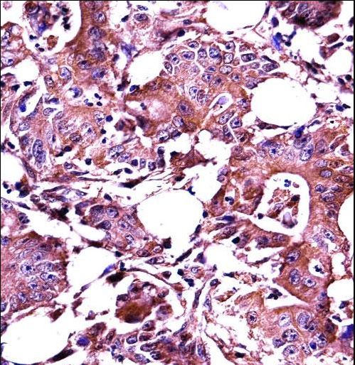 LGALS3 Antibody immunohistochemistry of formalin-fixed and paraffin-embedded human colon carcinoma followed by peroxidase-conjugated secondary antibody and DAB staining.