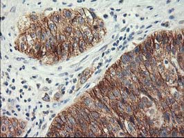 IHC of paraffin-embedded Carcinoma of Human bladder tissue using anti-LPL mouse monoclonal antibody.