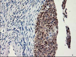 IHC of paraffin-embedded Adenocarcinoma of Human ovary tissue using anti-LPL mouse monoclonal antibody.