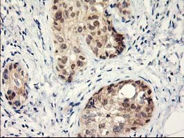 IHC of paraffin-embedded Adenocarcinoma of Human breast tissue using anti-LPL mouse monoclonal antibody.