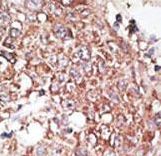 Formalin-fixed and paraffin-embedded human cancer tissue reacted with the primary antibody, which was peroxidase-conjugated to the secondary antibody, followed by DAB staining. This data demonstrates the use of this antibody for immunohistochemistry; clinical relevance has not been evaluated. BC = breast carcinoma; HC = hepatocarcinoma.