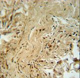 MAPK14 Antibody (T180/Y182)immunohistochemistry of formalin-fixed and paraffin-embedded human lung carcinoma followed by peroxidase-conjugated secondary antibody and DAB staining. This data demonstrates the use of the MAPK14 Antibody (T180/Y182) for immunohistochemistry.