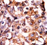 Formalin-fixed and paraffin-embedded human cancer tissue reacted with the primary antibody, which was peroxidase-conjugated to the secondary antibody, followed by AEC staining. This data demonstrates the use of this antibody for immunohistochemistry; clinical relevance has not been evaluated. BC = breast carcinoma; HC = hepatocarcinoma.