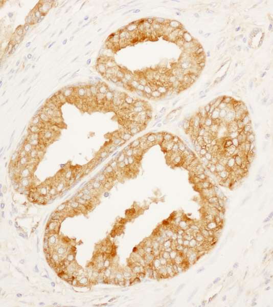 Detection of Human MARCKS-like 1 by Immunohistochemistry. Sample: FFPE section of human prostate carcinoma. Antibody: Affinity purified rabbit anti-MARCKS-like 1 used at a dilution of 1:1000 (1 ug/ml). Detection: DAB.