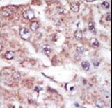 Formalin-fixed and paraffin-embedded human cancer tissue reacted with the primary antibody, which was peroxidase-conjugated to the secondary antibody, followed by AEC staining. This data demonstrates the use of this antibody for immunohistochemistry; clinical relevance has not been evaluated. BC = breast carcinoma; HC = hepatocarcinoma.